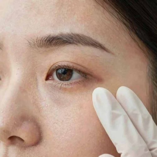 Tear Trough Filler Keighley