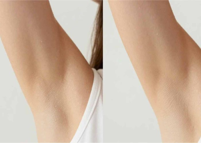 Hyperhidrosis Treatment Keighley