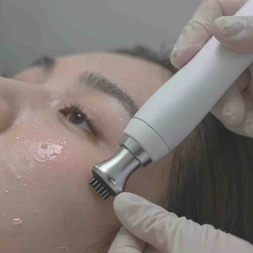 PRP Vampire Facial Keighley