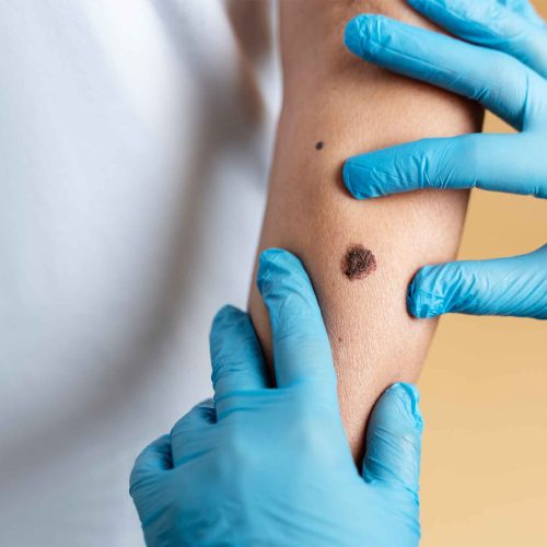 Wart Removal Skipton