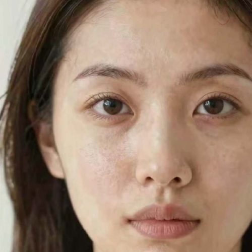 Microneedling skipton