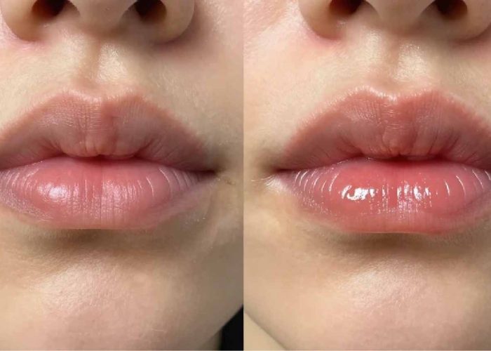 lip fillers keighley