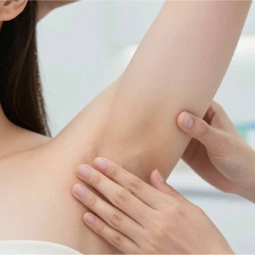 Hyperhidrosis Treatment Keighley