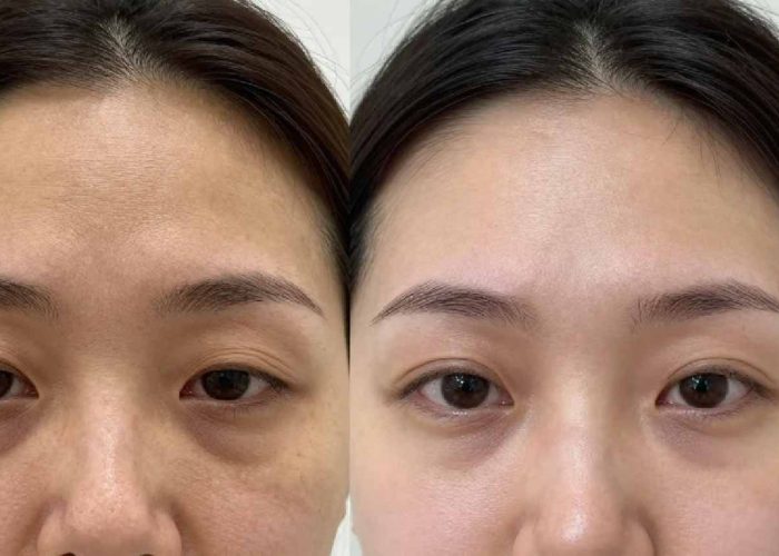 Anti Wrinkle Treatment keighley