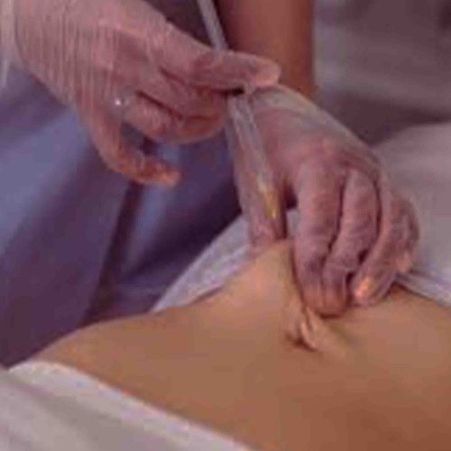 Fat Dissolving Treatment Keighley