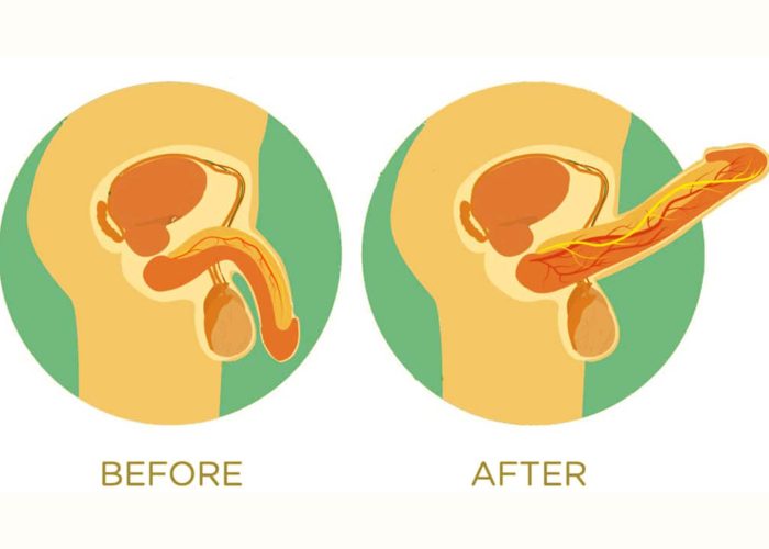 PRP for Erectile Dysfunction Keighley before and after
