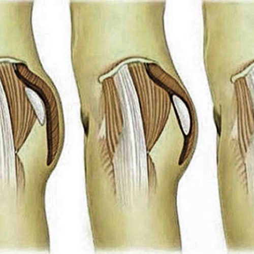 Buttock Augmentation Keighley