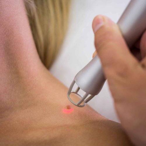 Wart Removal Skipton