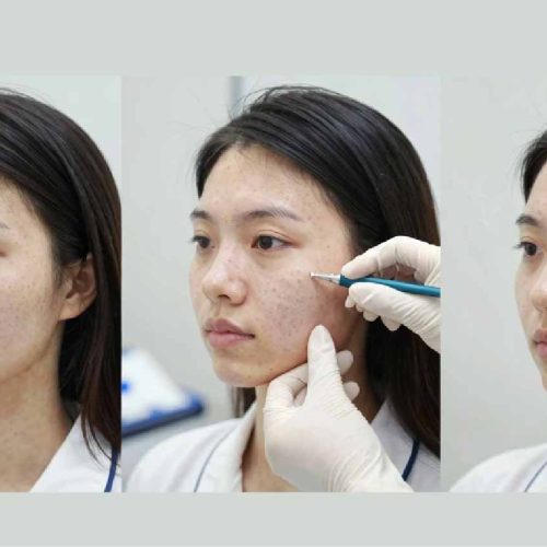 Jawline Filler Keighley