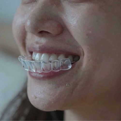 Bruxism Treatment Keighley