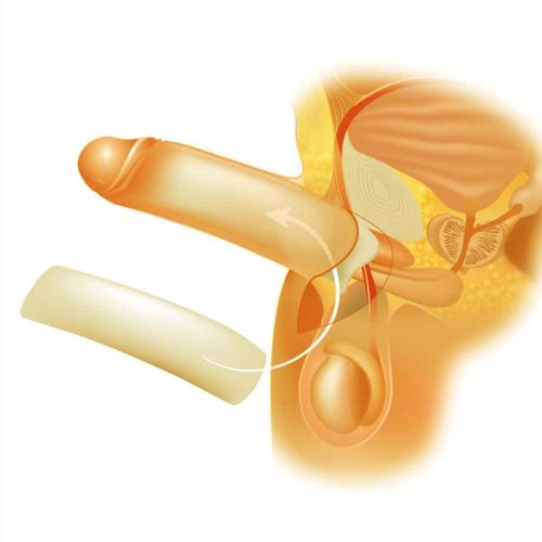 Penile Enlargement keighley