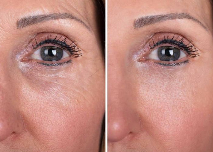 Tear Trough Filler Keighley