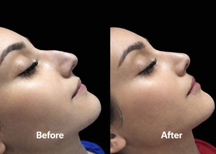 Non-Surgical Rhinoplasty Keighley