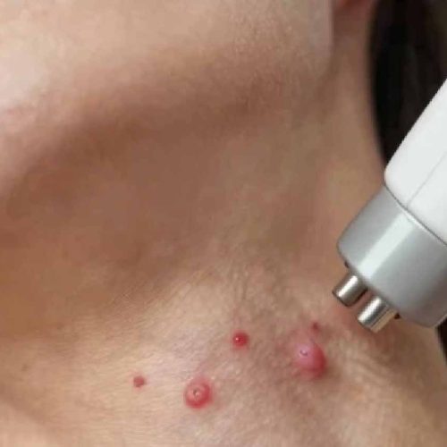Cherry Angioma Removal Skipton