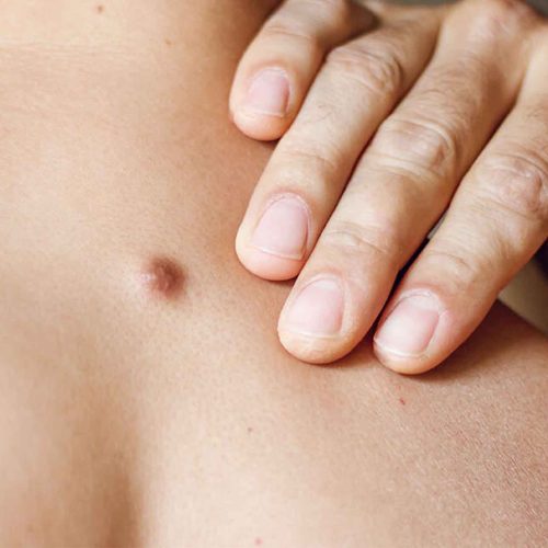 Cyst Removal Skipton