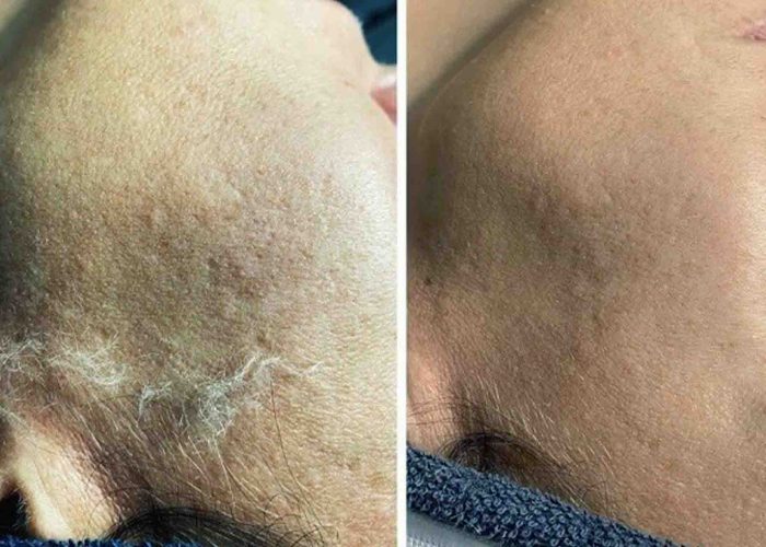 Dermaplaning Skipton