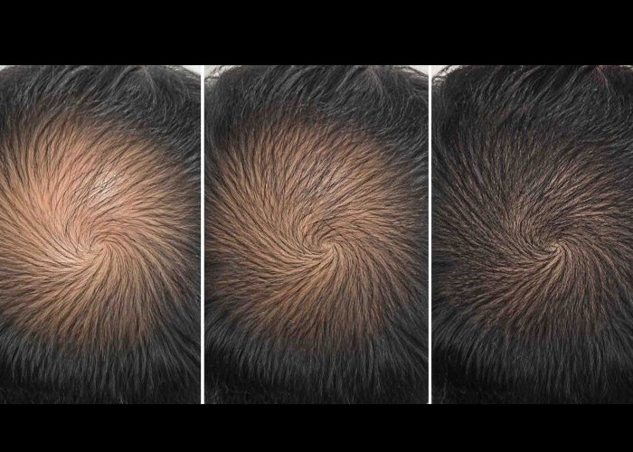 PRP Hair Restoration Keighley