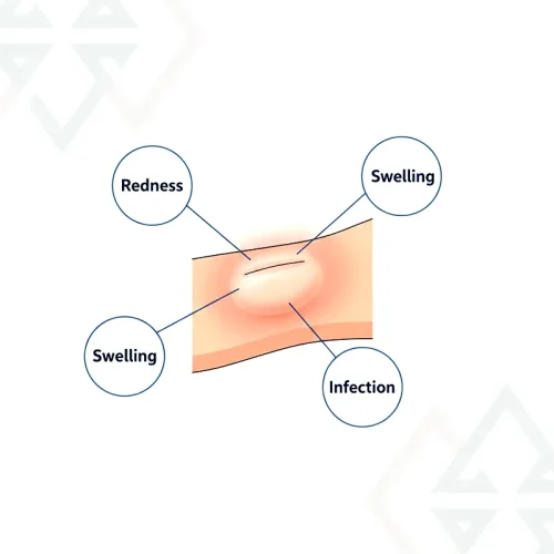 Cyst Removal Surgery