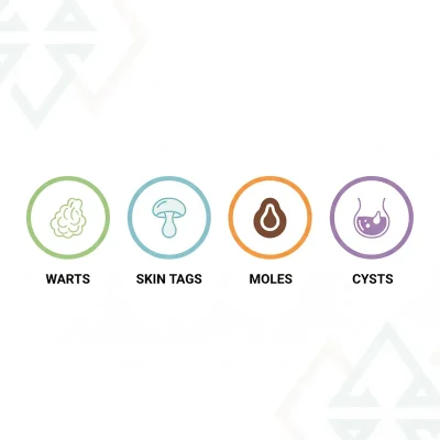 Wart Removal Keighley