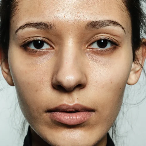 Microneedling at Pinnacle Clinic Microneedling at Pinnacle Clinic