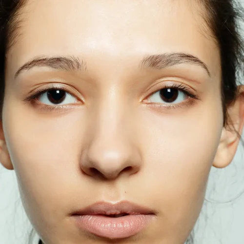 Microneedling at Pinnacle Clinic Microneedling at Pinnacle Clinic