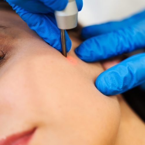 Skin tag removal keighley