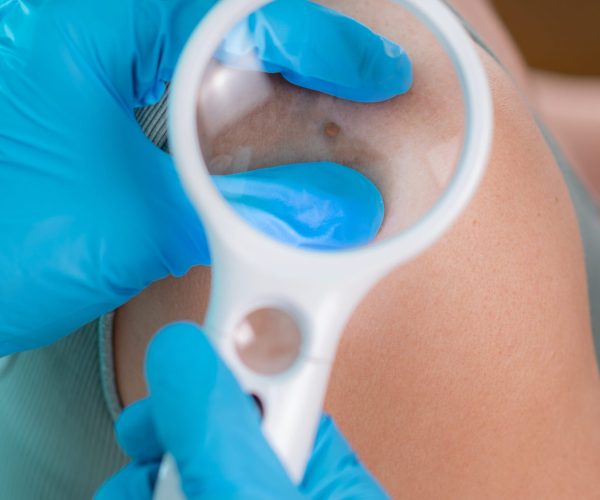 Skin tag removal keighley