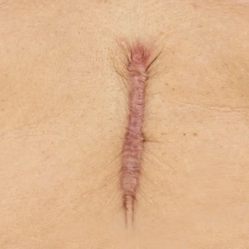 Keloid Scar Removal Keighley