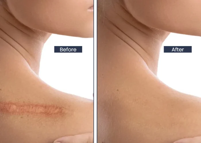 Keloid Scar Removal Keighley