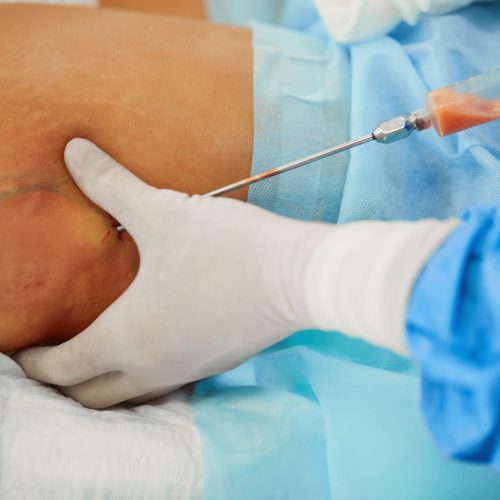 Lipoma Removal Keighley & Bradford