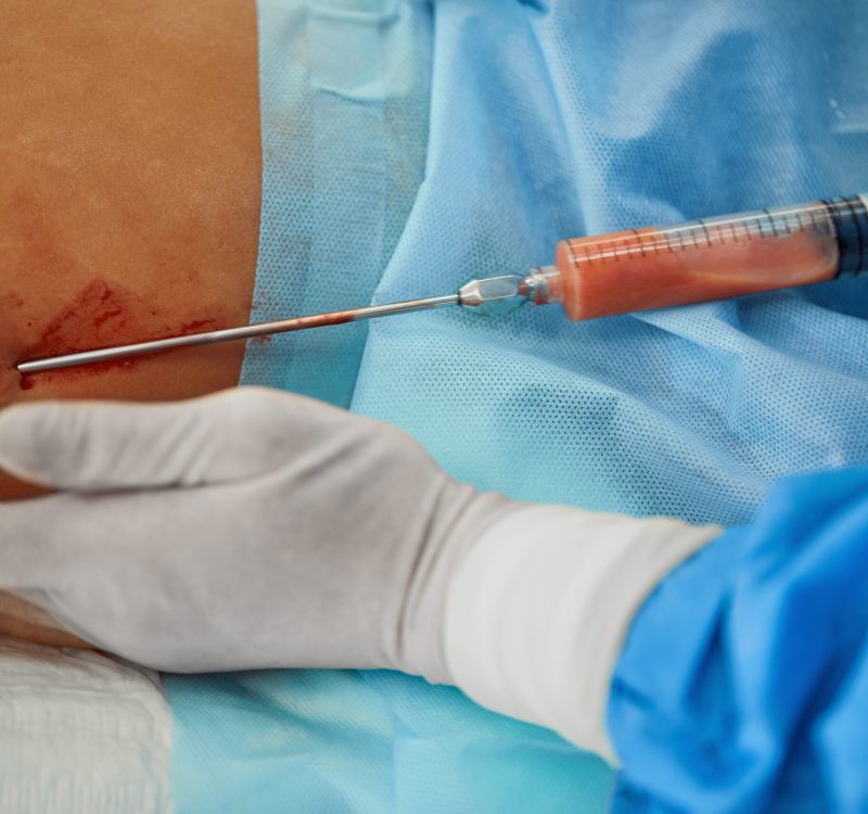 Lipoma Removal Keighley & Bradford