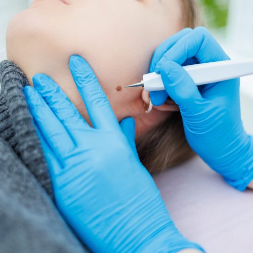 Skin tag removal keighley
